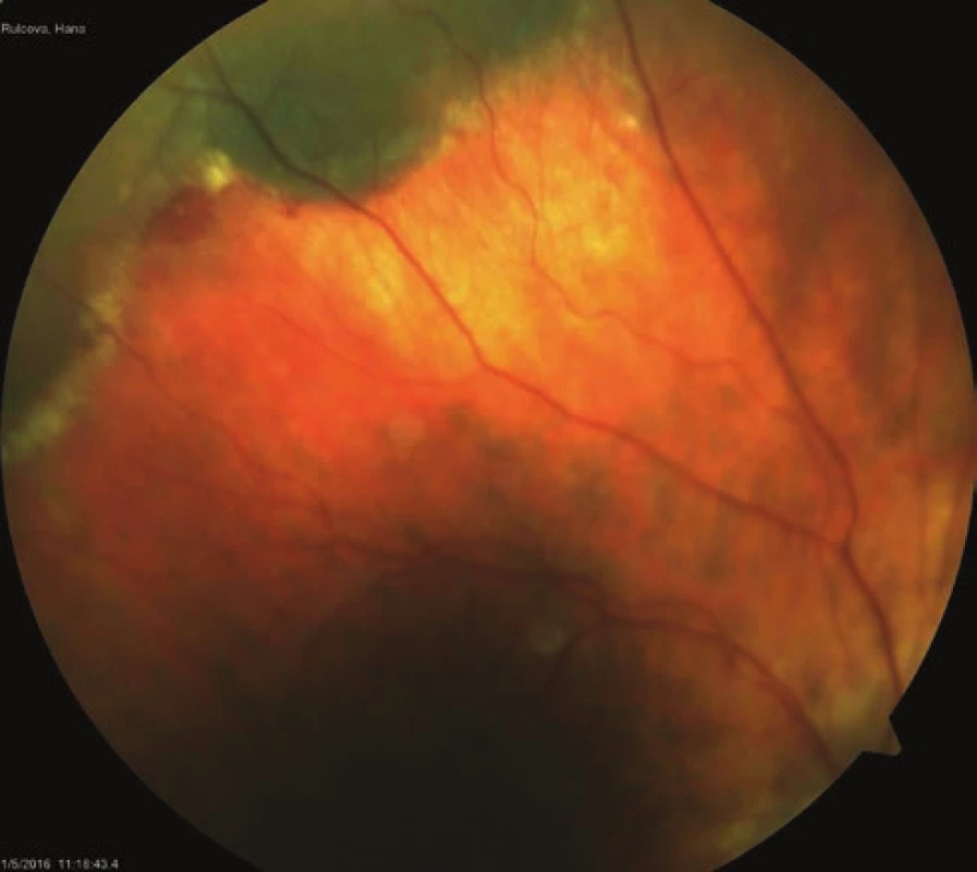 a. Sub-retinal and sub-RPE haemorrhages in LE
