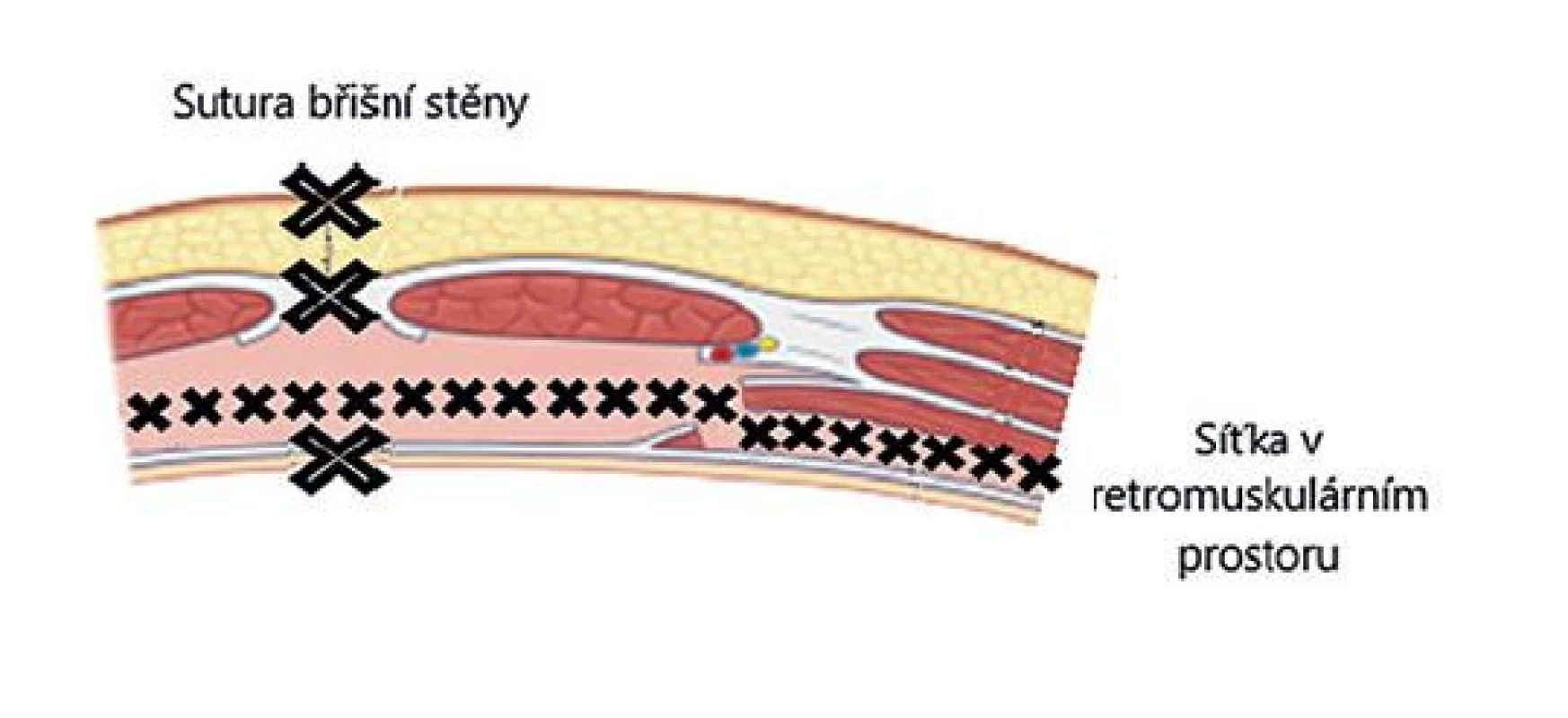 Schéma rekonstruované břišní stěny<br>
Fig. 7: Diagram of the reconstructed abdominal wall