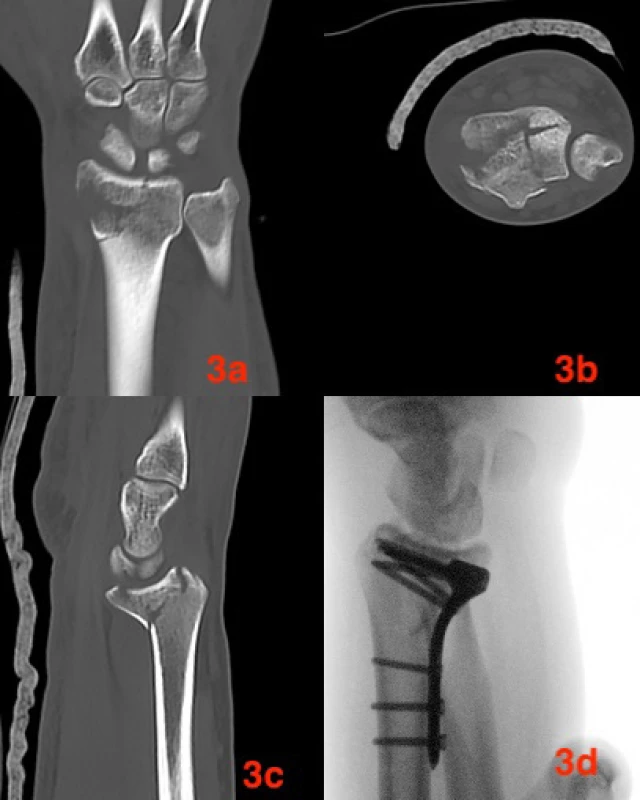  Pacient 32 let – zlomenina 2R3C3
3a CT frontální řez, 3b CT transverzální řez, 3c CT sagitální řez,
3d skiaskopická peroperační kontrola pozice dlahy.<br>
Fig. 3: Male patient, age 32 years – 2R3C3 fracture
3a CT coronal plane; 3b CT horizontal plane; 3c sagittal plane;
3d peroperative plate position under sciascopic control 