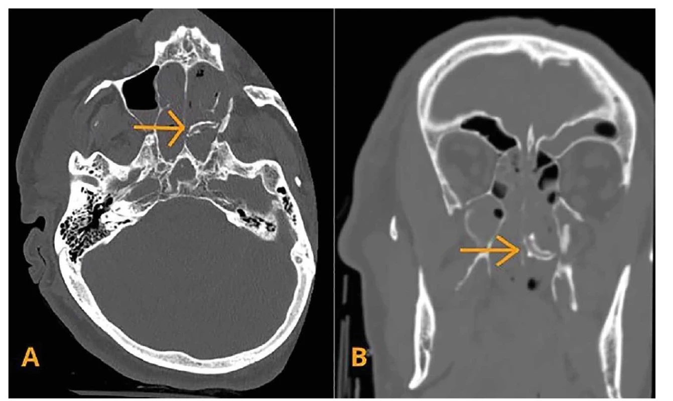 CT vyšetření baze lební a paranazálních dutin v kostní okně<br>
A – axiální sken, B – koronální sken. Cizí předmět v levém nosní průduchu označen šipkou.<br>
Fig. 1: CT examination of the skull base and paranasal sinuses in the bone window<br>
A – axial scan, B – coronal scan. Foreign body in the left nasal cavity indicated with an arrow.