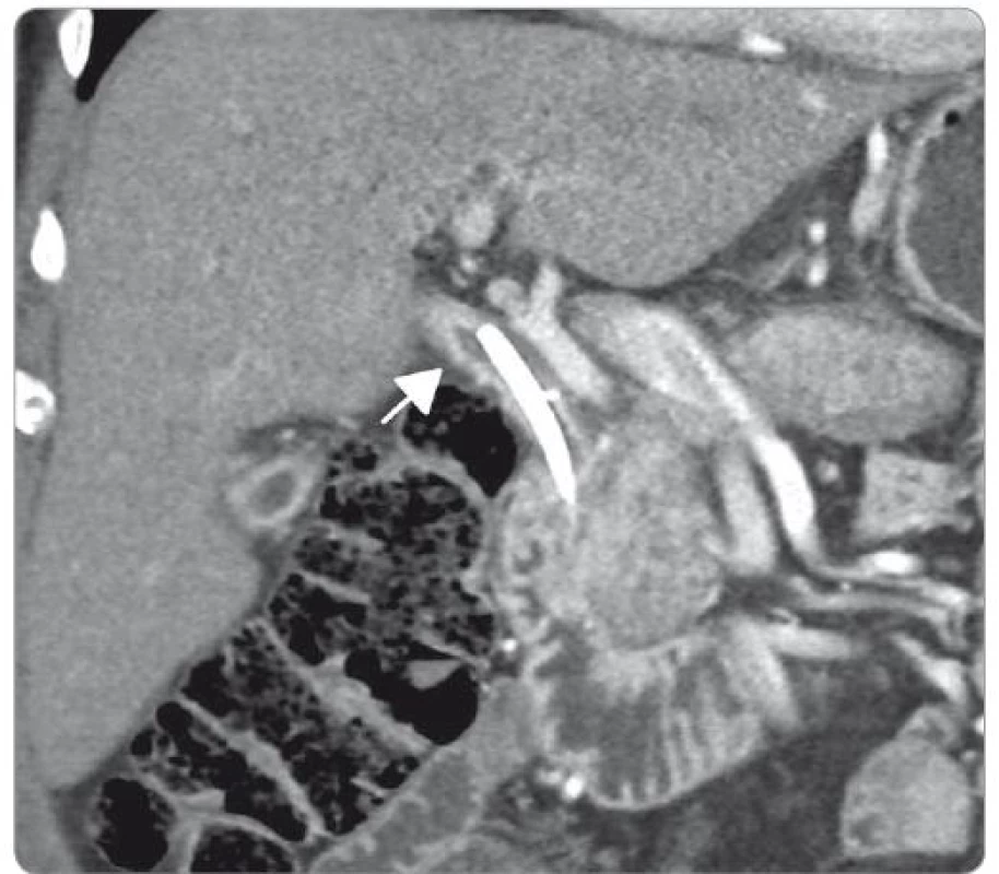 Zesílení stěny ductus choledochus, duodenobiliární drén in situ (CT vyšetření
s aplikací kontrastní látky, koronární rekonstrukce).