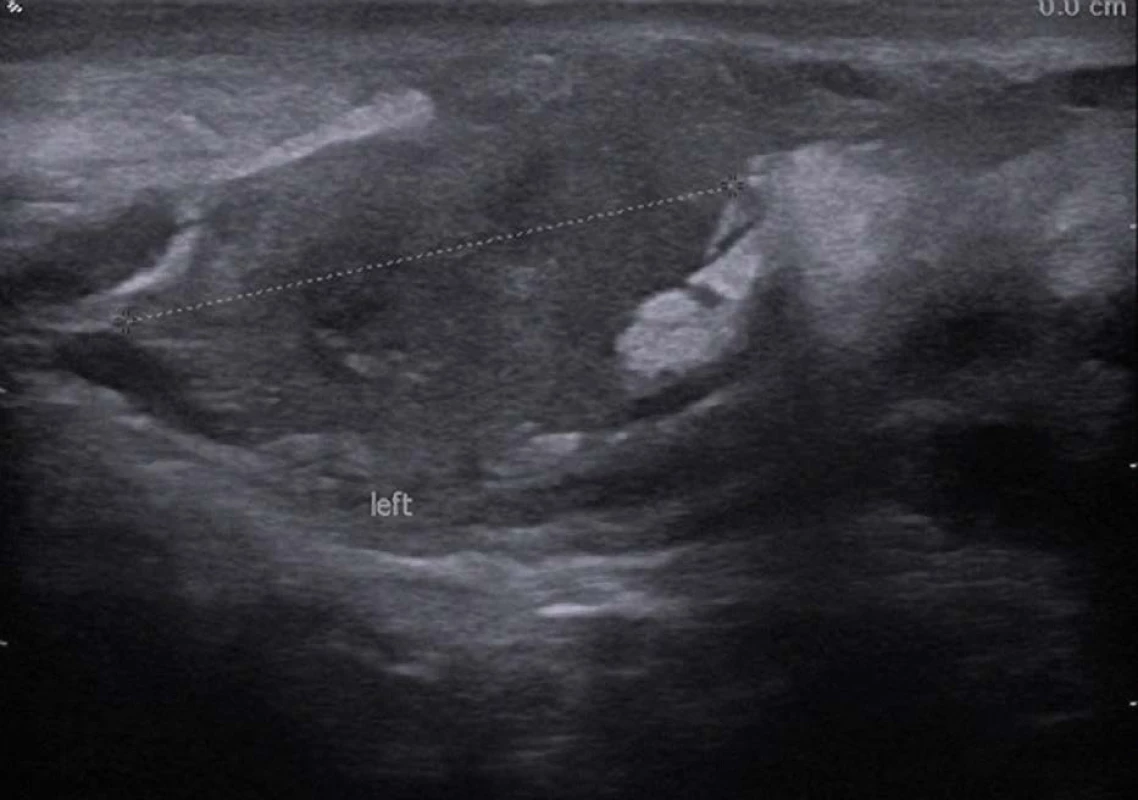 Ultrazvuk – eosinofilní funikulitida<br>
Fig. 1. Ultrasound – eosinophilic funiculitis