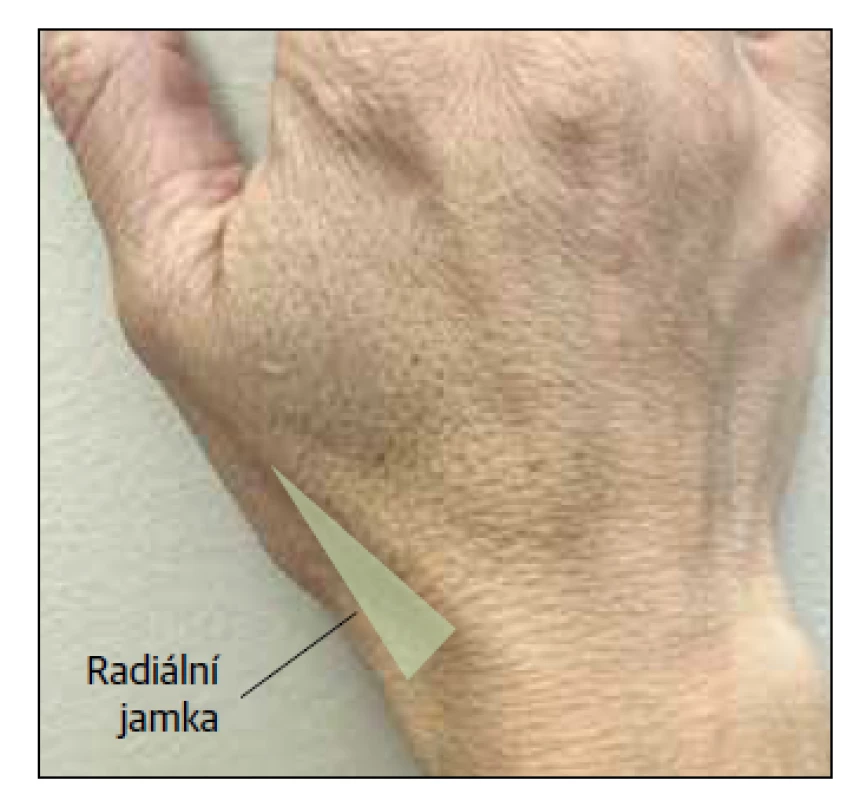 Radiální jamka. Citlivost při palpaci po
traumatickém poranění vyžaduje další vyšetření
zlomeniny skafoidu.