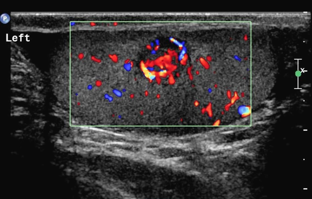 Duplexní ultrasonografie šourku: kuloidní ložisko levého varlete s hypoechogenní perfuzí<br>
Fig. 1. Duplex ultrasonography of the scrotum: orbicular focus of left testis with hypoechogenic perfusion