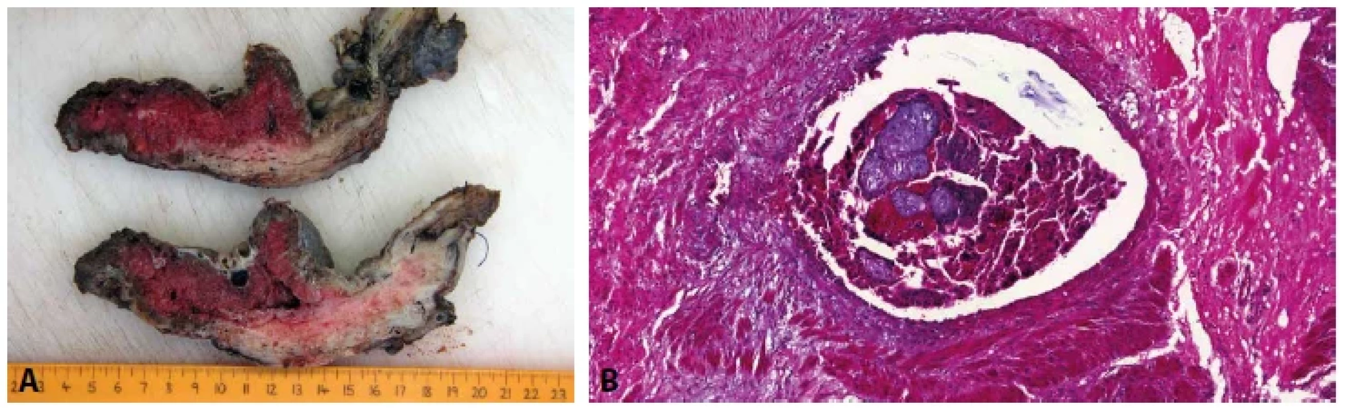 A: Placenta increta. Řezy děložní stěnou s patrným prorůstáním placenty do myometria. B: Placenta increta. Choriové klky v žíle stěny
děložní (HE, 200x).