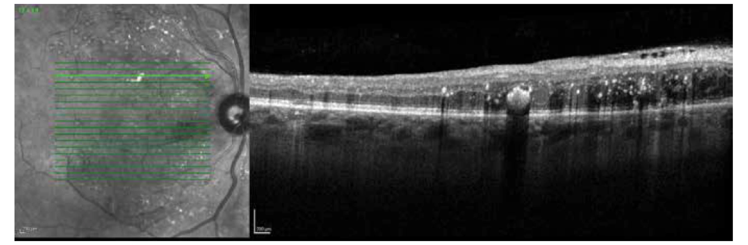 OCT horizontální přímý řez – diabetický makulární edém s přítomnou epiretinální membránou zvýrazněnou v horní nasální
části makuly – před operací