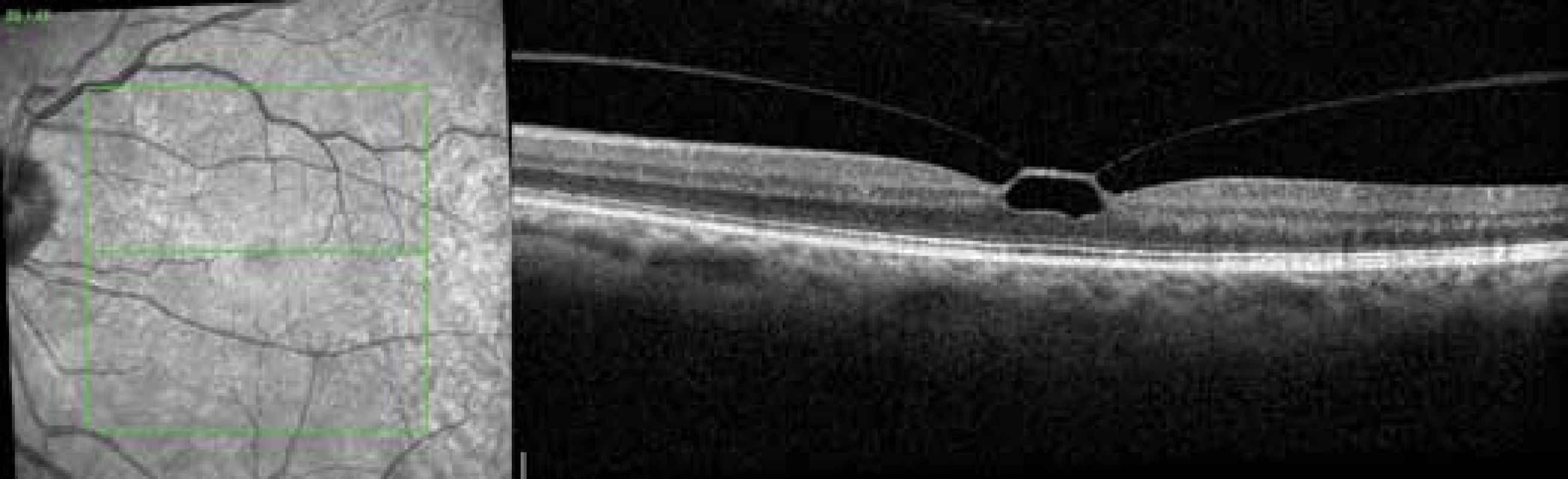 Vitreomacular traction before procedure