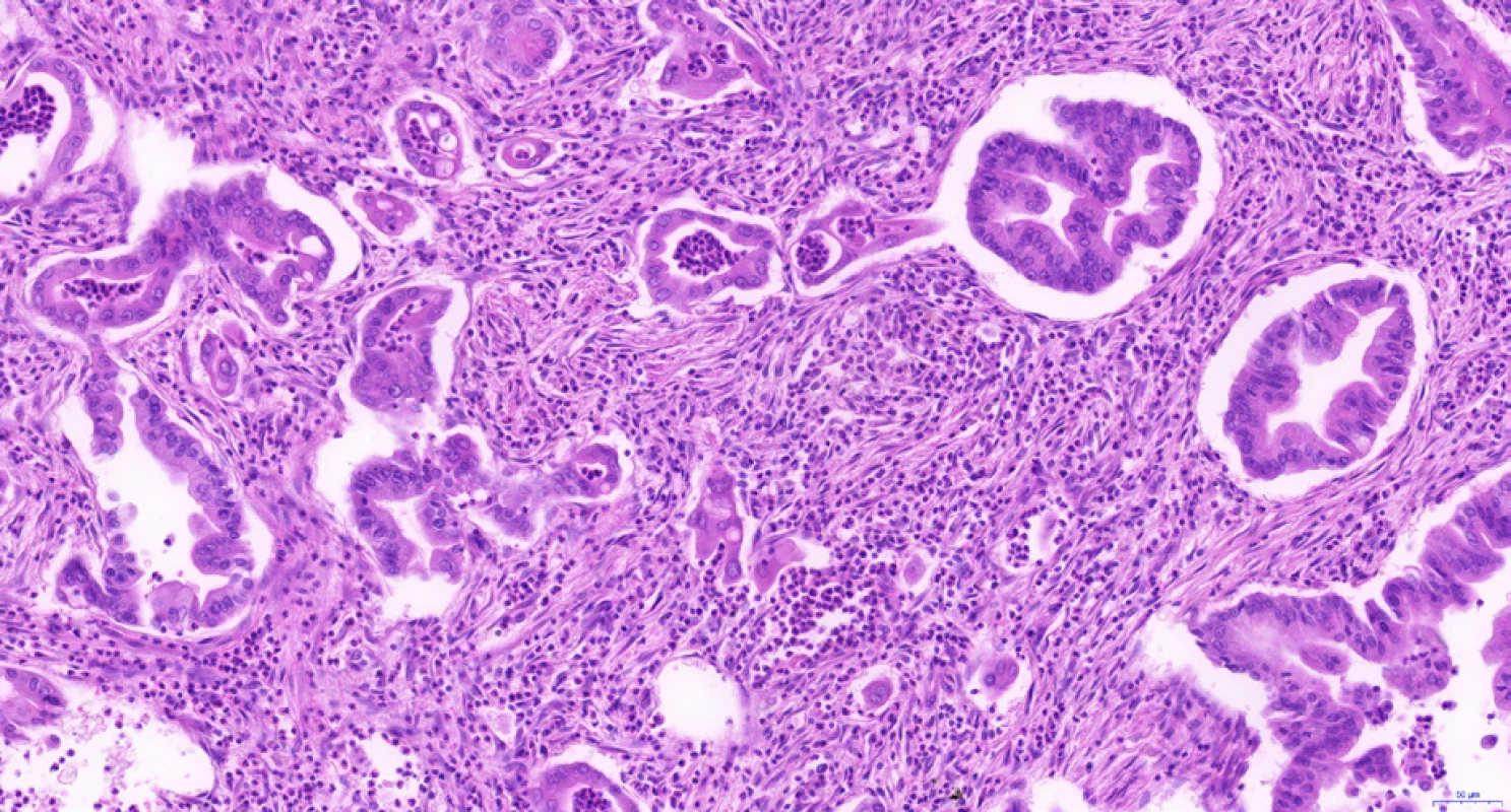 Cholangiocelulární karcinom extrahepatálních žlučovodů s charakteristickou tubulární stavbou. Nádor je tvořen angulovanými žlázkami, které jsou vystlány jednovrstevným cylindrickým epitelem s hlenotvorbou a výraznými jadernými atypiemi. Ve stromatu je desmoplazie a četné leukocyty při peritumorózním zánětu. Histologický řez z chirurgického resekátu, hematoxylin-eozin, 20×.