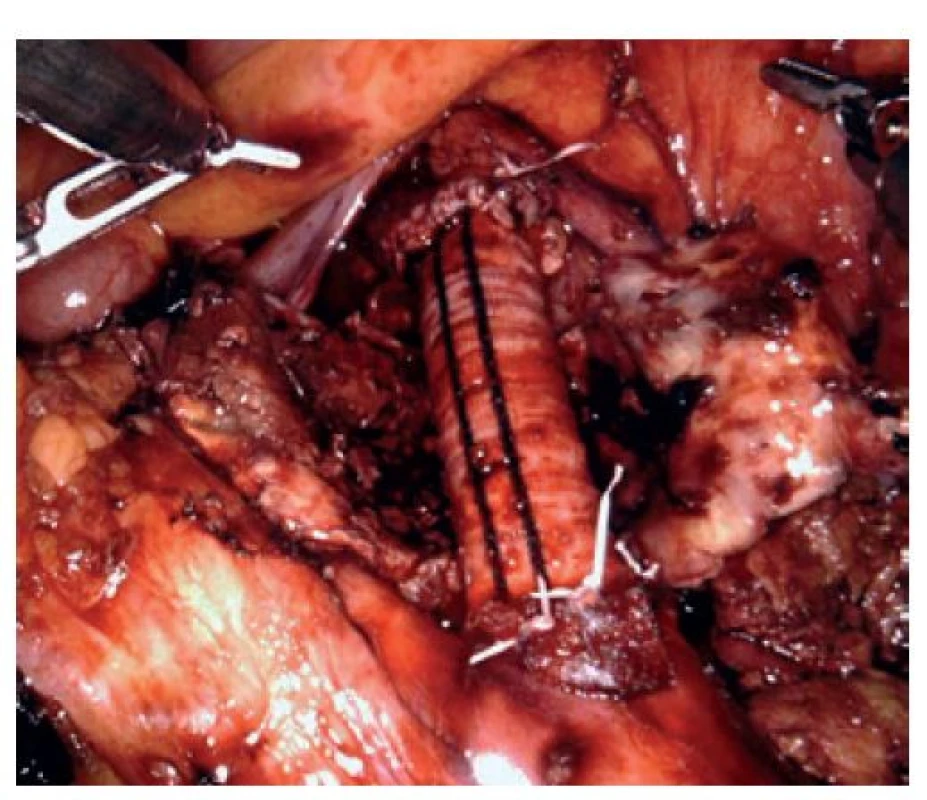 Robotická rekonstrukce výdutě pánevní tepny
(CT-AG)<br>
Fig. 5: Robotic common iliac artery aneurysm reconstruction
(CT-AG)