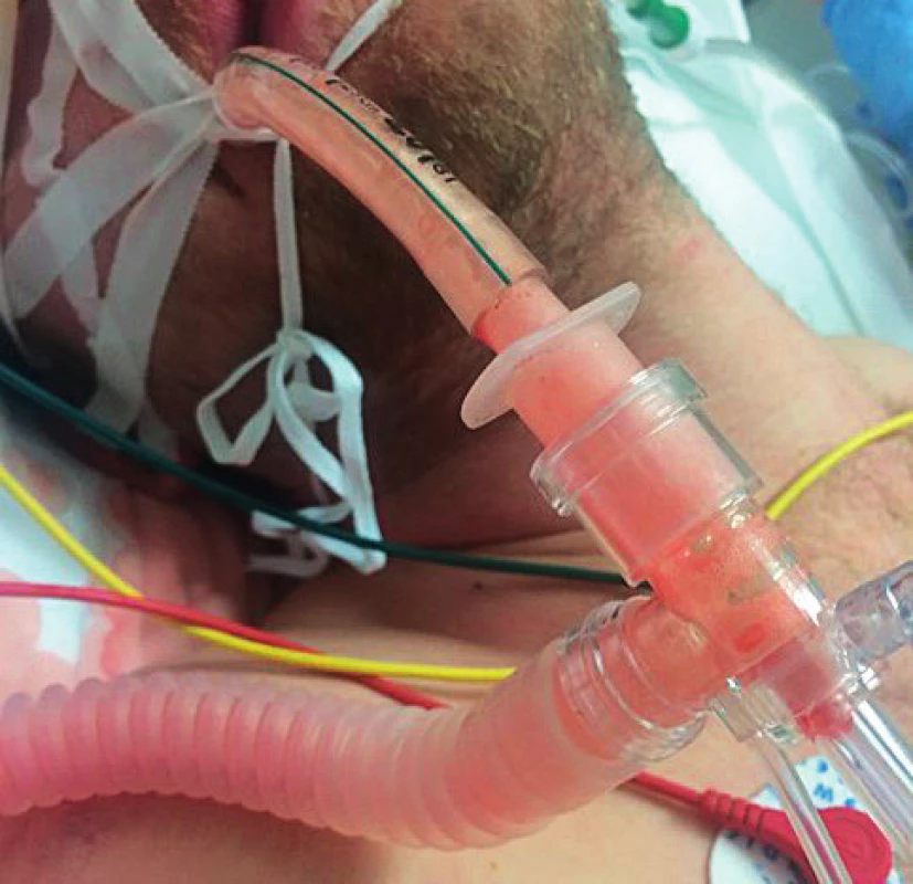 Zpěněné sputum v endotracheální kanyle
u pacienta z kazuistiky 3