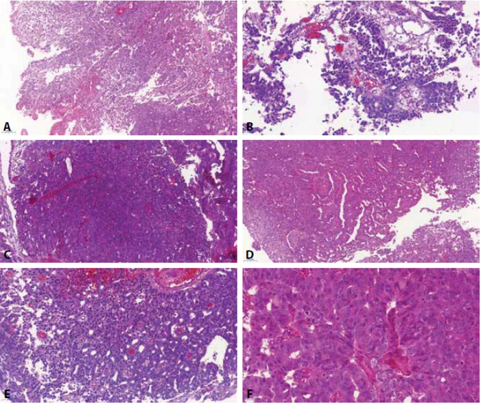 High-grade prostatický adenokarcinom napodobující uroteliální karcinom (prostatic adenocarcinoma mimicking urothelial carcinoma) - nádor je velice heterogenní, zastiženy jednak okrsky utvářející papilární/pseudopapilární struktury, s četnými odběrovými artefakty (A, B), místy pak nádor vytváří solidní okrsky (C). V materiálu však byly zastiženy i struktury napodobující mikropapilární uspořádání (D) a naznačená tvorba glandulárních struktur (E). Jádra mají výrazná prominentní jadérka (F).