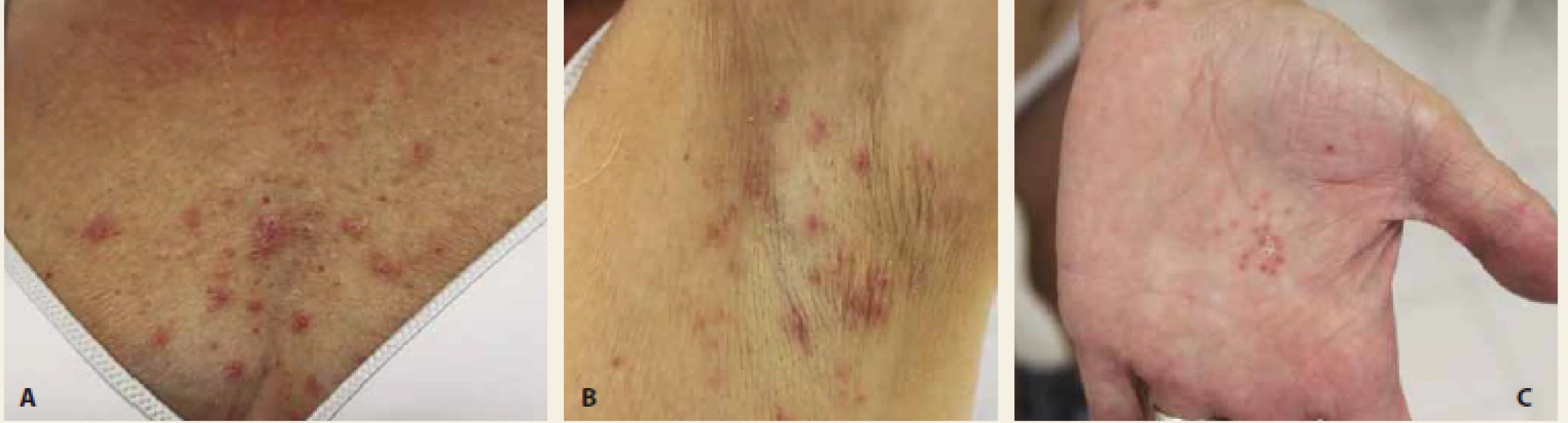 A – Prejavy guttátnej psoriázy; B – prejavy hidradenitis suppurativa; C – začiatok vzniku palmoplantárnej pustulózy
(25. 9. 2018).<br>
Fig. 1. A – Guttate psoriasis; B – manifestations of hidradenitis suppurativa; C – the onset of palmoplantar pustulosis
(25th of September 2018).