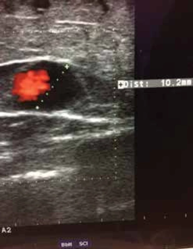 Dopplerovská ultrasonografie vena saphena magna –
Valsalvův fenomén a diametr žíly