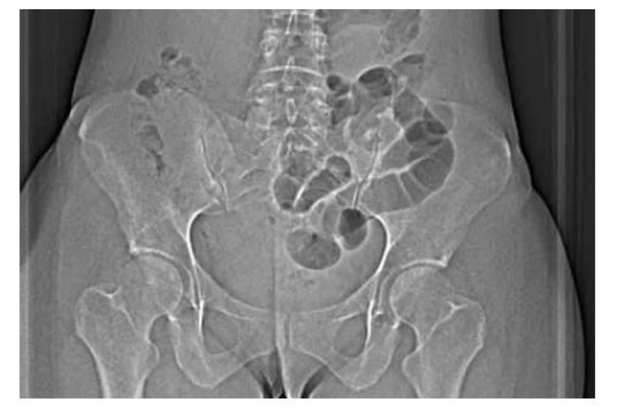 Přehledový CT scan<br>
Fig. 3: General CT scan