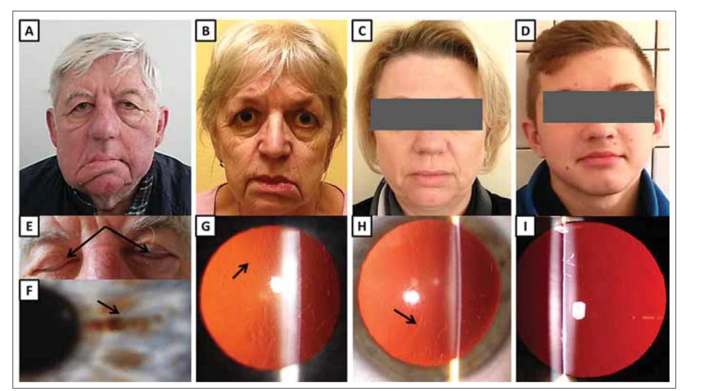 Klinické nálezy u jedinců s hereditární gelsolinovou amyloidózou z rodiny B.<br>
(A) Maskovitý vzhled obličeje 68letého muže (jedinec II:2) s ochablou kůží, povislými víčky a pokleslými koutky úst jako projev zjevné léze
n. facialis, která je obzvláště patrná na pravé straně.<br>
(B) 65letá žena (II:4) s ochablými očními víčky, pokleslými koutky úst a mírně odstávajícím dolním rtem, zejména vlevo.<br>
(C) 46letá žena (III:6) s povislou kůži v obličeji.<br>
(D) 14letý nositel patogenní mutace (IV:2) bez klinických projevů hereditární gelsolinové amyloidózy.<br>
(E) Lagoftalmus (šipky) u 68letého muže (II:2).<br>
(F) Rohovka stejného pacienta (II:2) s lineárními depozity (šipka).<br>
(G) Rohovka ženy (II:4) zobrazující lineární a větvící se depozita (šipka).<br>
(H) Rohovka ženy (III:6) zobrazující lineární a větvící se depozita (šipka).<br>
(I) Čirá rohovka asymptomatického muže (IV:2).<br>
Fig. 2. Clinical findings in subject with hereditary gelsolin amyloidosis from family B.<br>
(A) A 68-year-old male (II:2) with a mask-like facial appearance, cutis laxa, drooping eyelids and mouth as a result of obvious facial nerve
lesion, especially on the right side.<br>
(B) A 65-year-old female (II:4) with drooping eyelids, mouth corners and mild protrusion of her lower lip, which is more pronounced on the
left side.<br>
(C) A 46-year-old female (III:6) with drooping facial skin.<br>
(D) A 14-year-old male with pathogenic mutation (IV:2) without clinical signs of hereditary gelsolin amyloidosis.<br>
(E) Lagophthalmos (arrows) in a 68-year-old male (II:2).<br>
(F) Cornea of the same patient (II:2) containing linear deposits (arrow).<br>
(G) Cornea of female (II:4) showing linear branching deposits (arrow).<br>
(H) Cornea of female (III:6) showing linear branching deposits (arrow).<br>
(I) Clear cornea of asymptomatic male (IV:2).