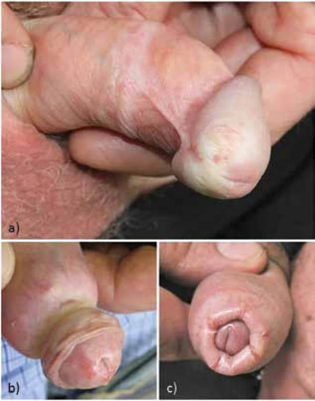 Bělavě prosáklý glans se zřaseným povrchem, zkrácené
frenulum, fibrotický cirkulární prstenec preputia (a), parafimóza
fibrotickým prstencem (b), fimóza pro zúžení preputia s ragádami
fragilního fibrotického preputia (c)