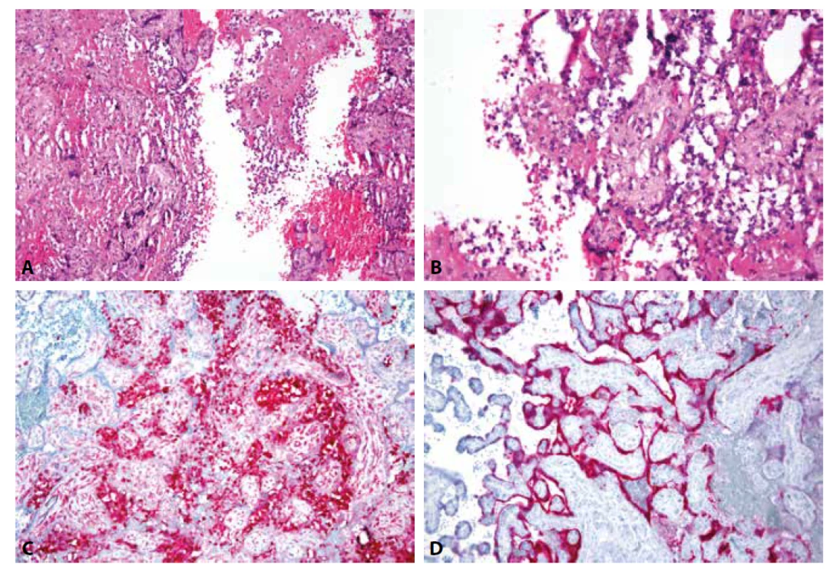 A: SARS-CoV-2 placentitida: Chronická histiocytární intervilositida s depozity perivilózního fibrinoidu a nekrózou vilózního trofoblastu (HE, 200x). <br>
B: Chronická zánětlivá celulizace s příměsí neutrofilních granulocytů v intervilózních prostorách, destrukce vilózního trofoblastu (HE, 400x).<br>
C: Imunohistochemický průkaz histiocytů v intervilózních prostorách (CD68, 200x). <br>
D: Imunohistochemický průkaz virového nukleokapsidového proteinu v cytoplazmě vilózního trofoblastu (SARS-CoV-2 BioSB, 200x).