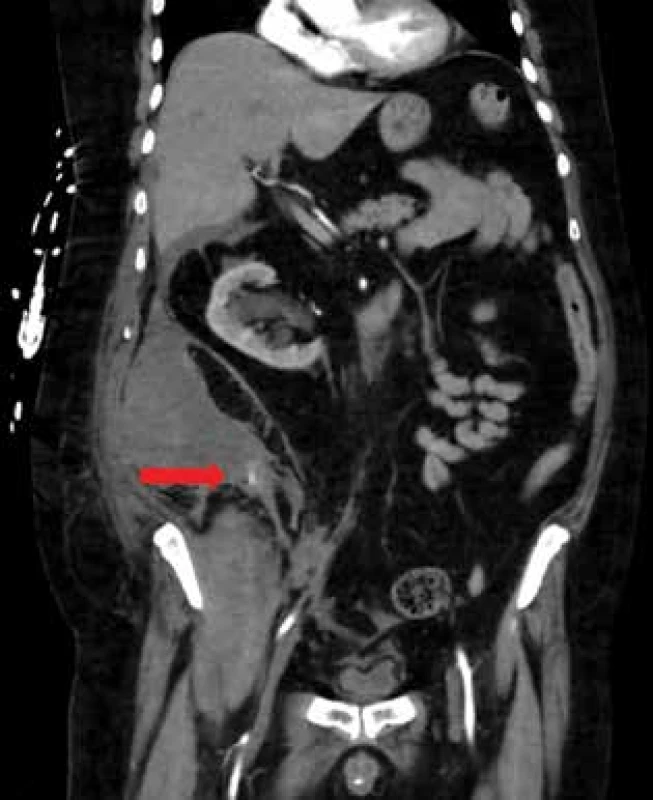 CT frontální řez: hematom retroperitonea vpravo
s viditelným krvácením v mediokaudální porci (označeno
šipkou)<br>
Fig. 1: CT (coronal scan): hematoma of the retroperitoneum
on the right with visible bleeding in the mediocaudal
part (indicated by an arrow)