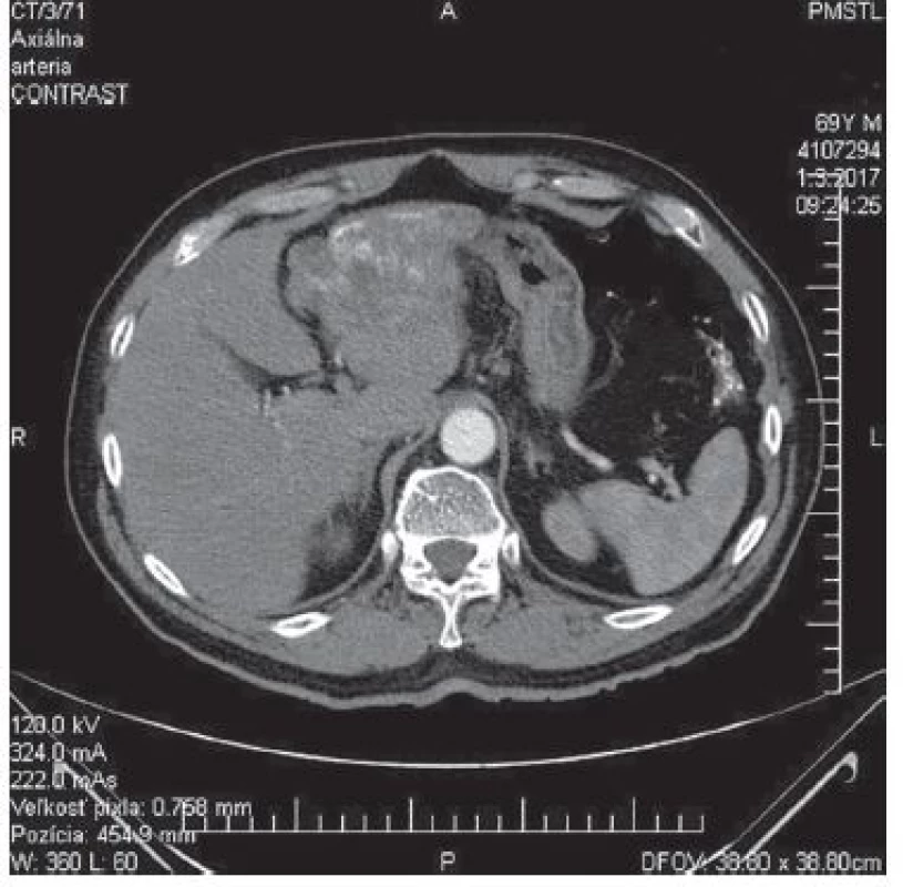 CT − arteriálna fáza, axiálny<br>
Fig. 1: CT − arterial phase, axial