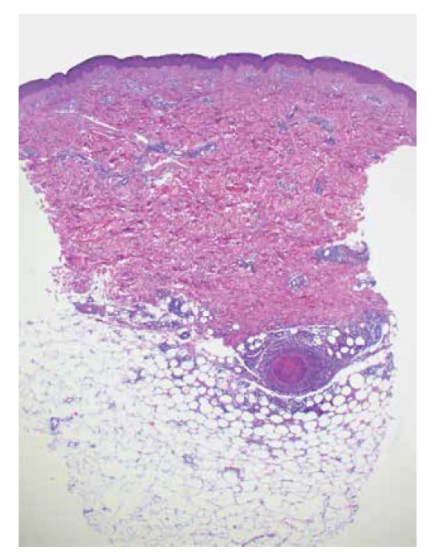 Nekrotizující vaskulitida středně velké arterie v podkožní
tukové tkáni u polyarteriitis nodosa (HE 25 x)