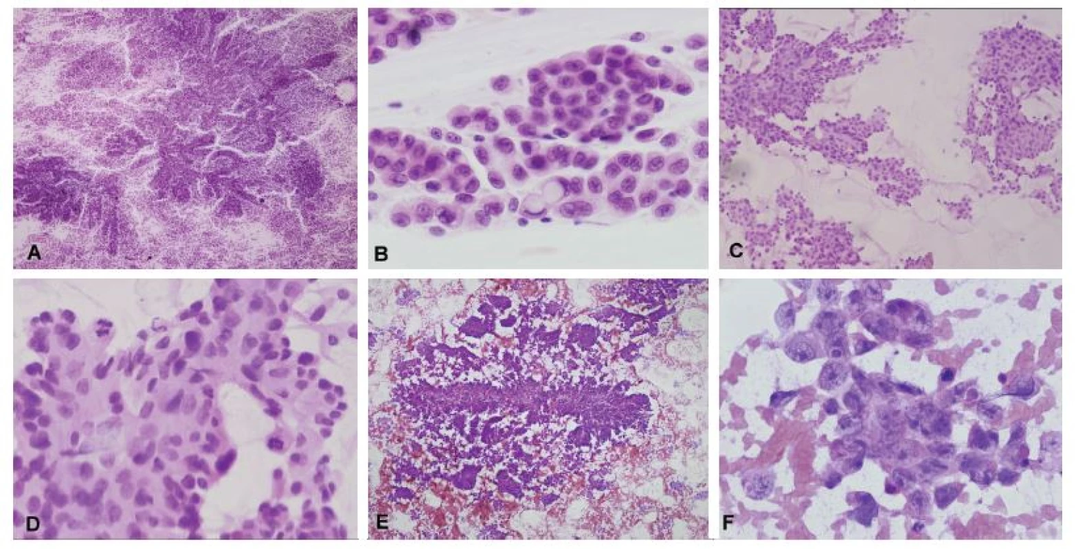 (A, B) Biopsia supratentoriálneho ložiska u 35-ročnej ženy. V náterovej cytológii boli zachytené papilárne formácie kohezívnych epiteloidných buniek
(A). V niektorých bunkách bola prítomná intracelulárna produkcia mucínu (B). Peroperačná diagnóza: metastáza adenokarcinómu. Definitívna diagnóza: metastáza
papilárneho adenokarcinómu pľúc. (C, D) Biopsia solitárneho ložiska u 63-ročného muža. V cytológii zachytené kohezívne plachtovité formácie epiteloidních
buniek. Ložiskovo naznačené glandulárne/acinárne štruktúry (C). Išlo o mierne atypické bunky s objemnou kolumnárnou cytoplazmou s početnými
mitózami (D). Peroperačná diagnóza: metastáza karcinómu, skôr adenokarcinómu. Definitívna diagnóza: metastáza acinárneho karcinómu prostaty. (E, F)
Biopsia supratentoriálneho ložiska u 19-ročného muža s anamnézou testikulárneho seminómu. V cytológii zachytené naznačene papilárne formácie epiteloidných
buniek (E). Jednalo sa o výrazne atypické bunky s prominentními jadierkami a svetlo eozinofilnou cytoplazmou (F). Peroperačná diagnóza: metastáza
epitelového nádoru, mohlo by sa jednať o germ-cell tumor. Definitívna diagnóza: metastáza embryonálneho karcinómu.