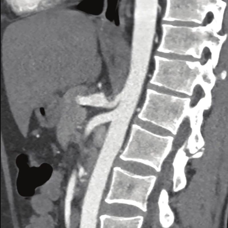 CT-angio nález kompresie truncus coeliacus<br>
Fig. 1: CT-angio celiac axis compression syndrome
