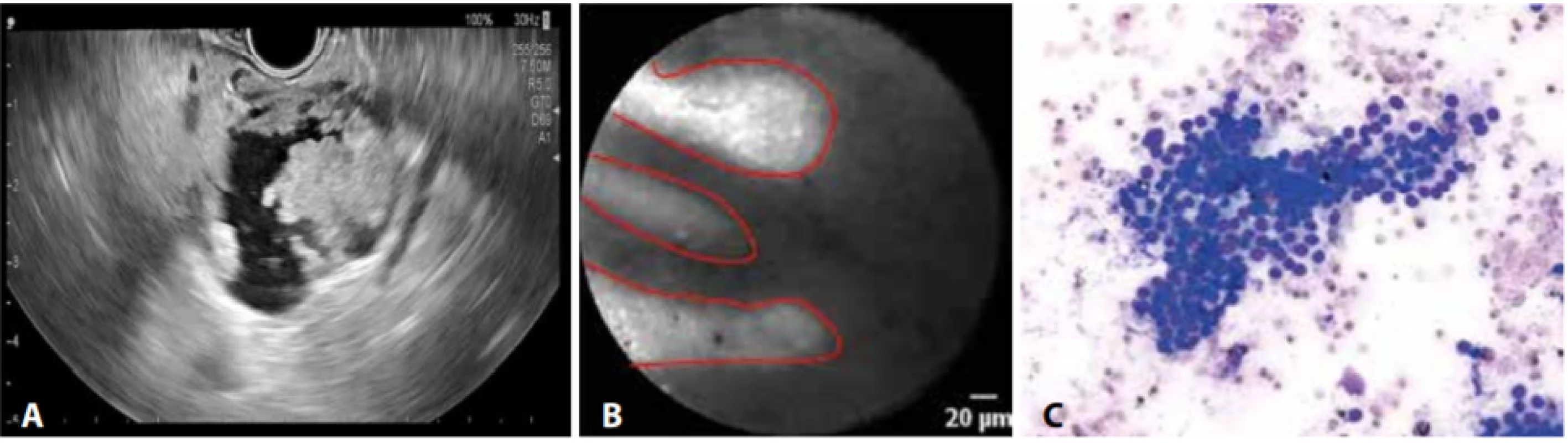 EUS (A), nCLE (B) a cytologie (C) pacienta s IPMN, v CLE charakteristický obraz „prstů“<br>
Fig. 3: EUS (A), nCLE (B) and cytology (C) of a patient with IPMN; CLE image with typical finger-like papillae
