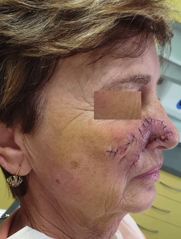 Condition 1 week after healing of the nasolabial flap (author’s archive)
