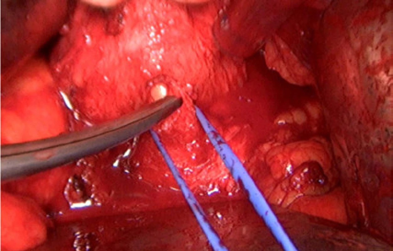 Přerušena ventrální část prostatické uretry<br>
Fig. 5. Transection of the anterior portion of the
prostatic urethra