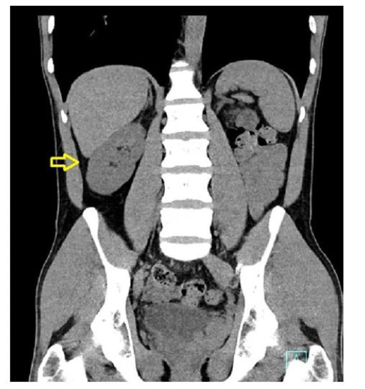 CT snímek solitární pravé ledviny<br>
Fig. 1. CT picture of solitary right kidney
