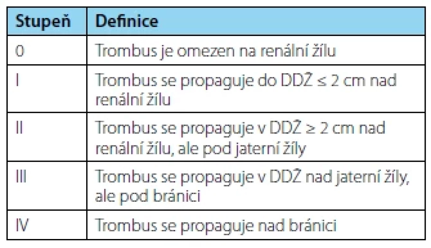 Klasifikace trombu dolní duté žíly podle Mayo
Clinic <br> 
Tab. 1. Mayo Clinic classification of Inferior Vena
Cava Throbus