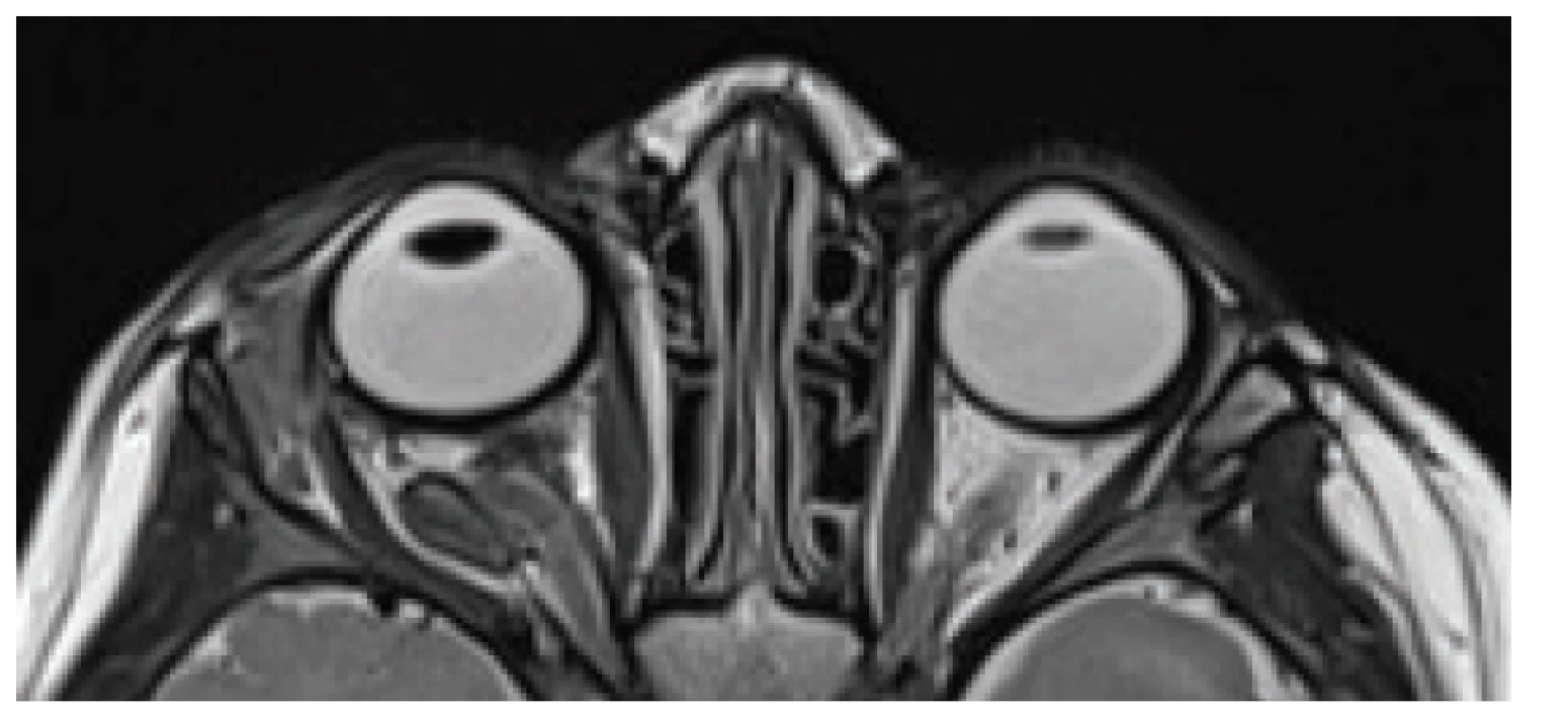 MRI examination 6 weeks after surgery. Persistent
enlargement of the right orbit, eyeball now without proptosis,
optic nerve sigmoid-coiled