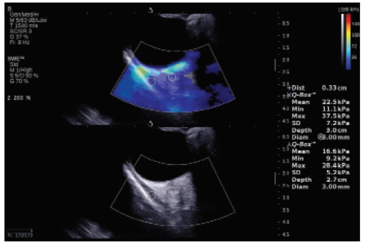 Measurement of elasticity of musculus rectus superior
in healthy individual