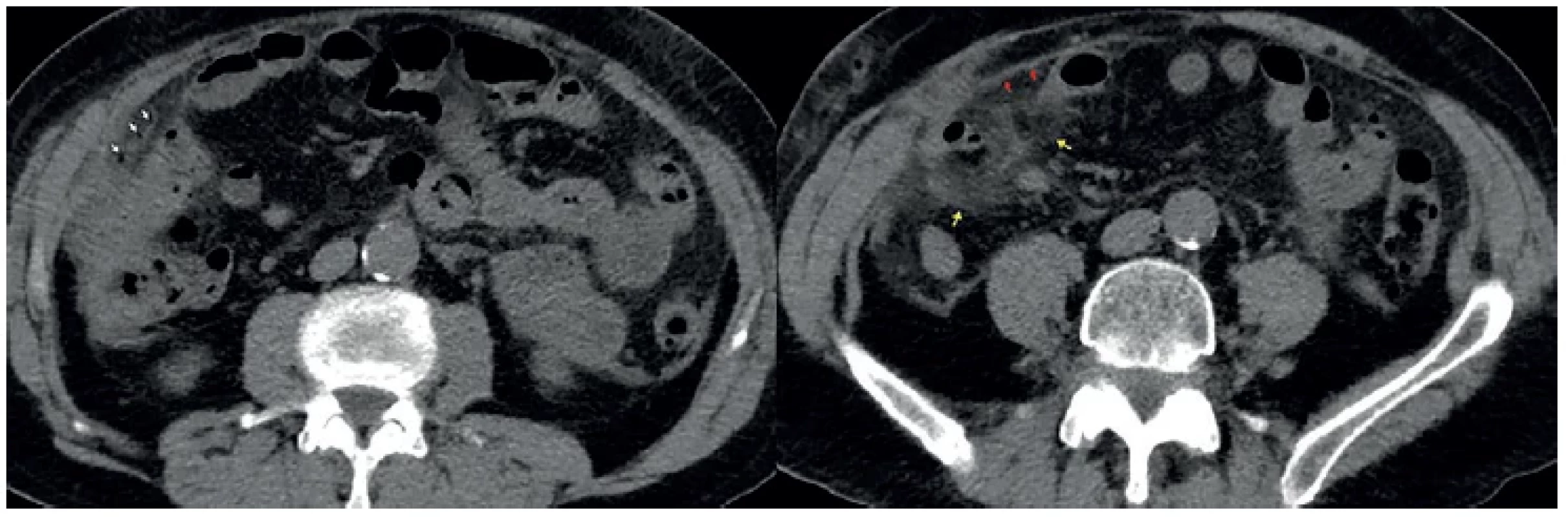 Divertikulitida ilea – CT břicha, nativně, axiální sken <br> 
Fig. 3. Diverticulitis of the ileum – CT scan of the abdomen, native, axial scan