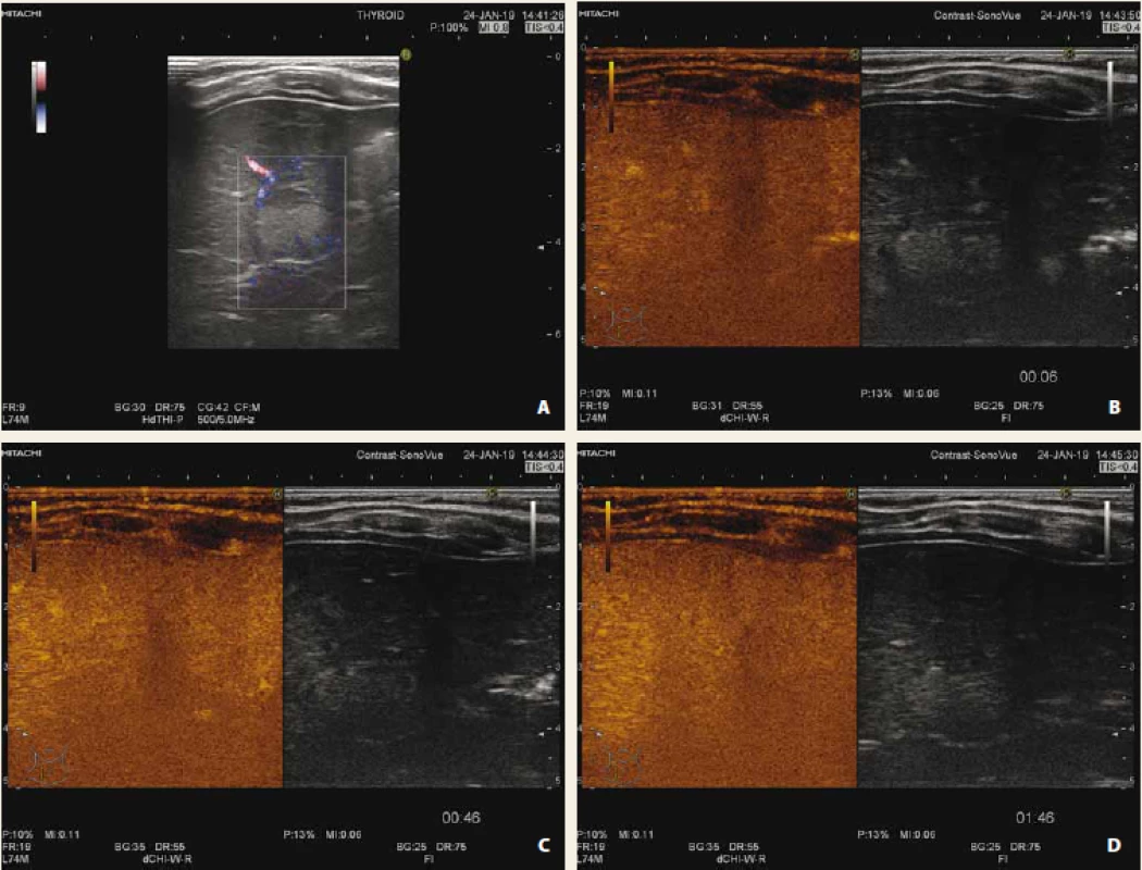 Fokální steatóza jater s využitím dopplerovského zobrazení (A), CEUS arteriální fáze (B), portální fáze (C),
pozdní fáze (D). Po podání kontrastní látky léze ve všech fázích splývá (je izoechogenní) s okolním
parenchymem jater.<br>
Fig. 2. Focal liver steatosis with use of doppler mode (A), CEUS arterial phase (B), portal phase (C), late phase (D).
After application of contrast agent, lesion is isoechogenic with surrounding liver parenchyma during all phases.