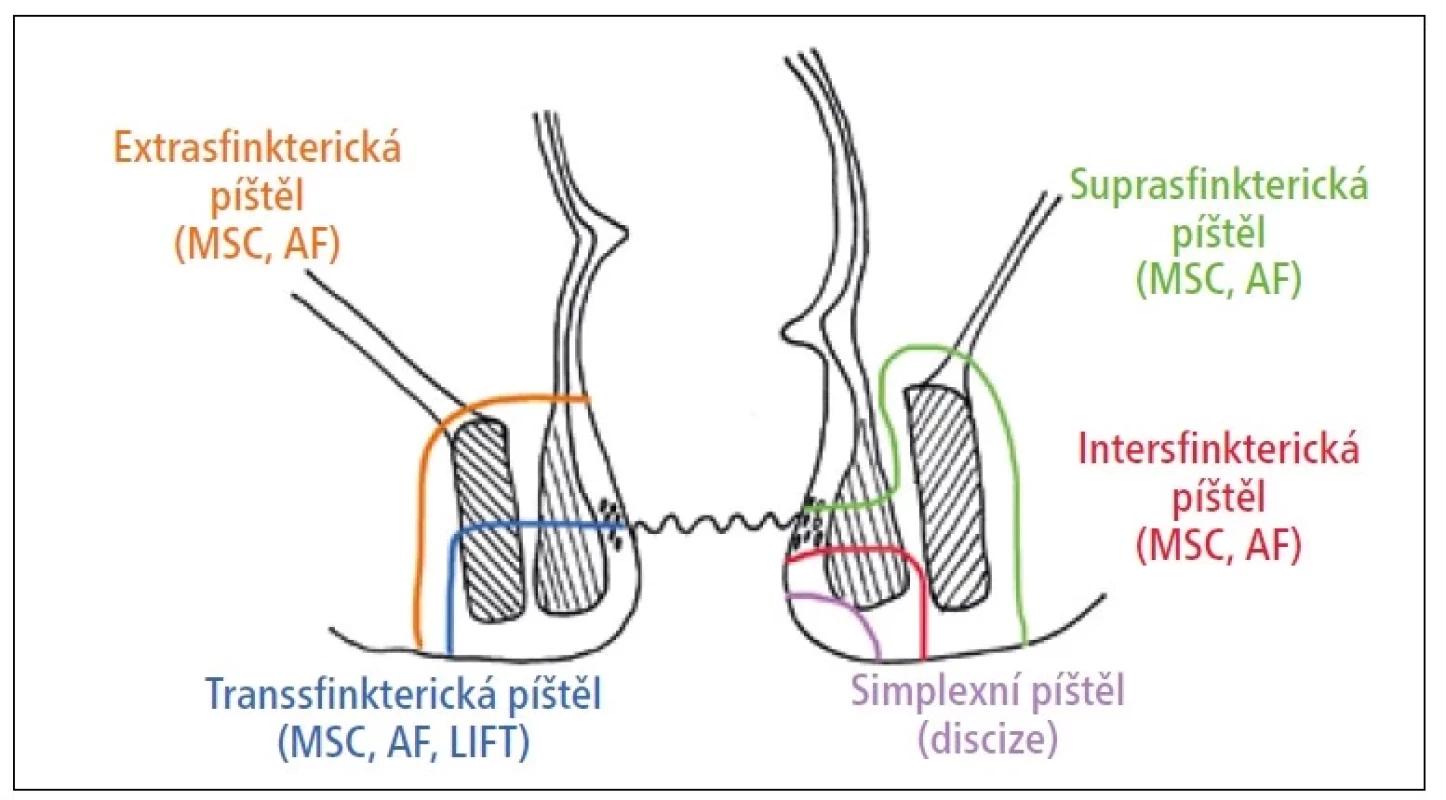 Schéma vztahu píštělových traktů ke sfinkterům a možnosti terapie. MSC – léčba kmenovými buňkami,
AF – endorektální plastika – advancement flap, LIFT – ligace intersfinkterického traktu