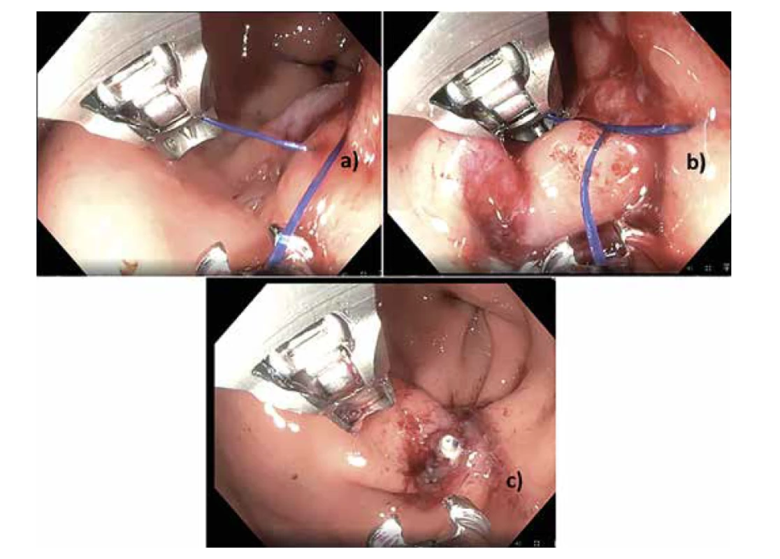 G-POEM, uzávěr incize pomocí endoskopického šicího systému (Apollo Endosurgery,
Austin, Texas)<br>
a) zahájení sutury b) pokračování sutury c) kompletní sutura<br>
Fig. 3: G-POEM, mucosal entry site closed with an endoscopic suturing system (Apollo Endosurgery,
Austin, Texas)<br>
a) Beginning of the suturing; b) Suturing in progress; c) Suturing completed