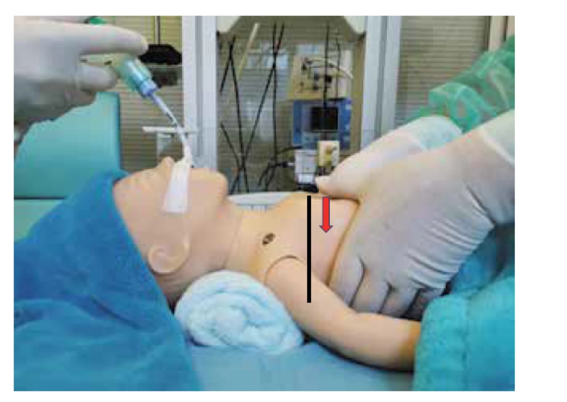 Hloubka kompresí cca do 1/3 předozadního průměru
hrudníku.<br>
Fig. 8. Depth of the chest compression approximately one-
-third of the anterior-posterior diameter.