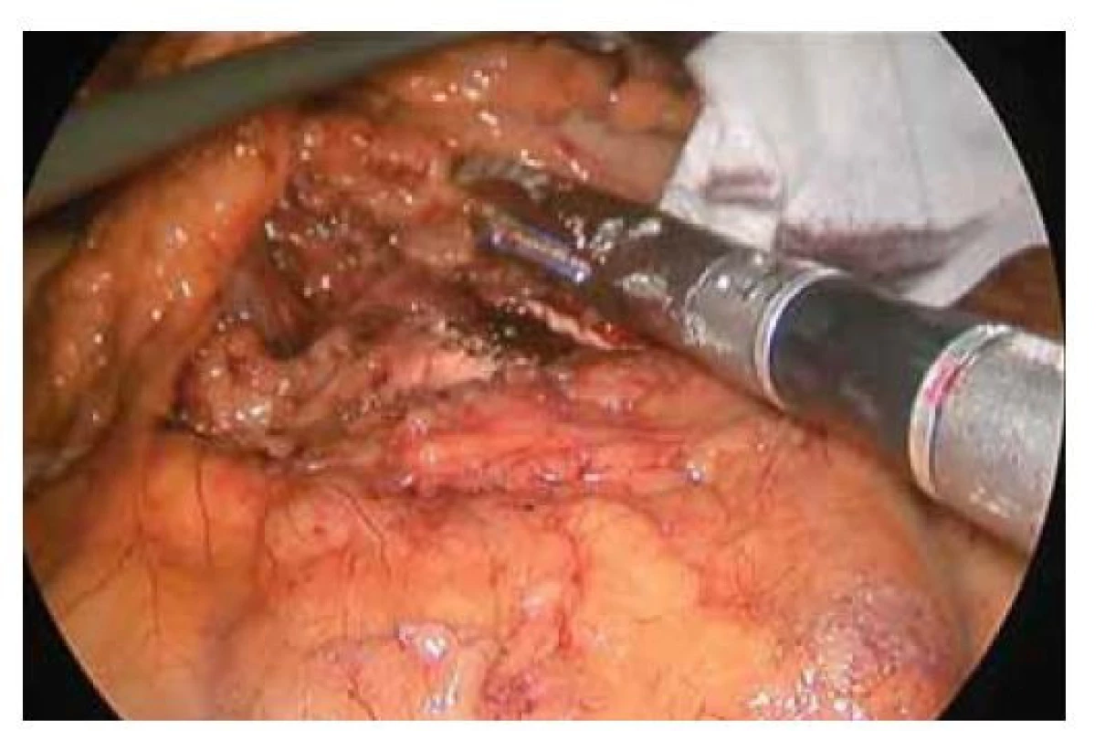Přerušení pankreatu pomocí stapleru.<br>
Fig. 1. Stapler transection of the pancreas.