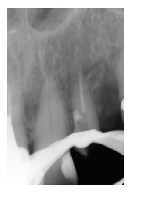 Oprava perforácie za pomoci<br>
biokeramického materiálu<br>
ProRoot® MTA<br>
Fig. 2<br>
Perforation repair<br>
by bioceramic material<br>
ProRoot® MTA