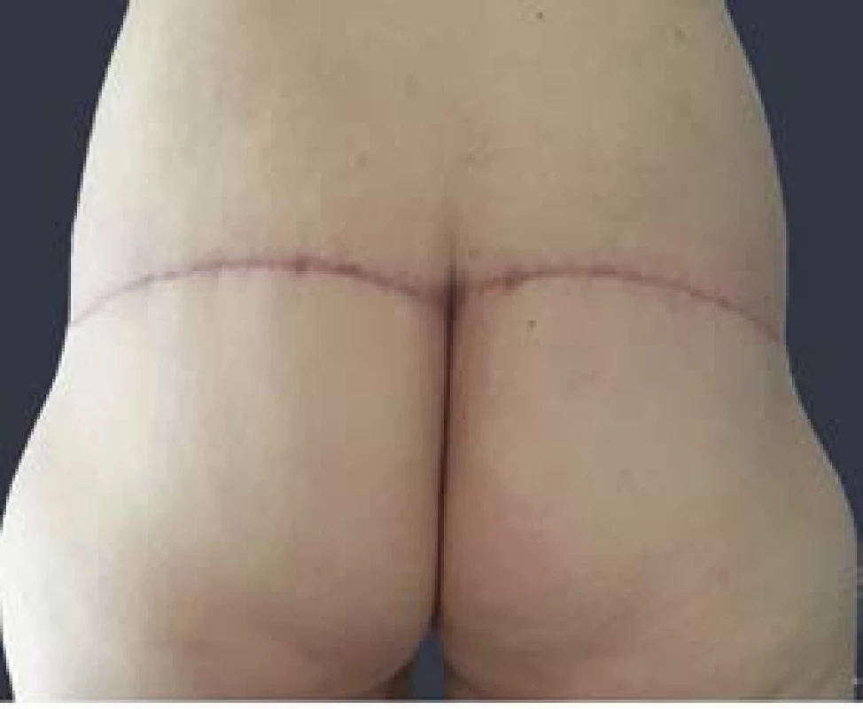 Gluteoplastika – pooperační foto, 5 měsíců po výkonu