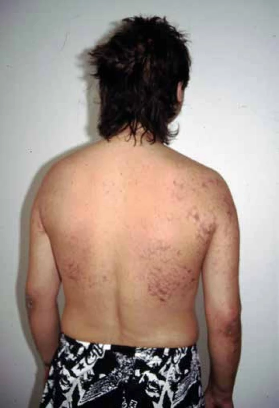 Polyarteritis nodosa – livedo reticularis.