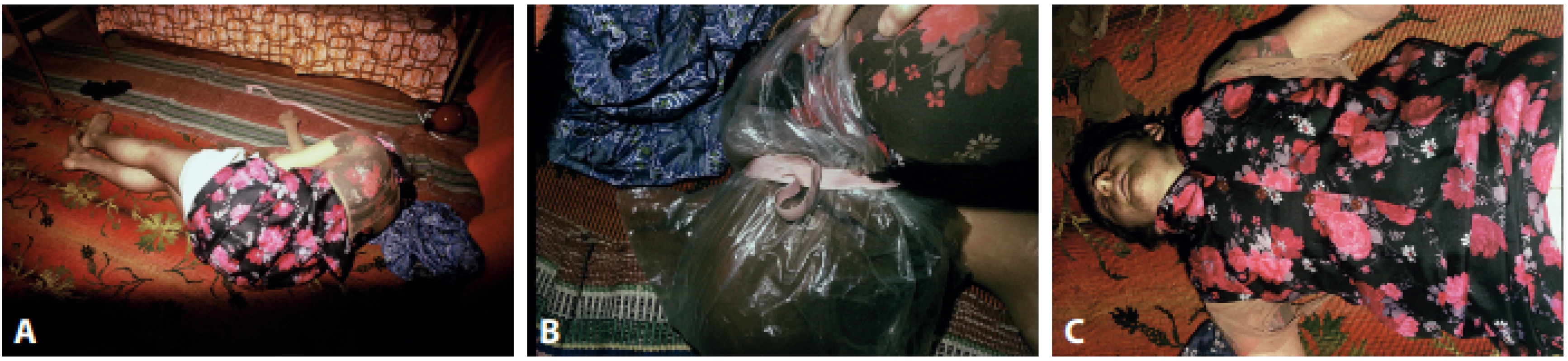 The body scene of 18-year-old young man. A: Position of the deceased at the death scene. B: A plastic bag wrapped around the head of the deceased
with a tape. C: The young man dressed in women´s clothing. 