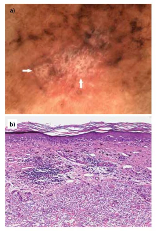 Pacientka, 72 let, lentigo maligna melanom (Breslow
0,2 mm) z dorzální strany levého předloktí<br>
a) dermatoskopický obraz s přítomností jasných bílých
proužků (šipky), zároveň jsou přítomny šedo-černé tečky
jakožto příznak regrese<br>
b) histopatologický obraz s vyjádřenými regresivními změnami
v podobě novotvořené fibrotizace a zánětlivým infiltrátem
sahajícím do hloubky 0,5 mm (HE, 100x).