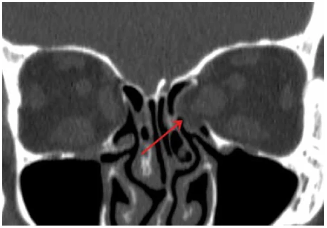 Computer tomography – finding after orbital decompression on left (arrow)