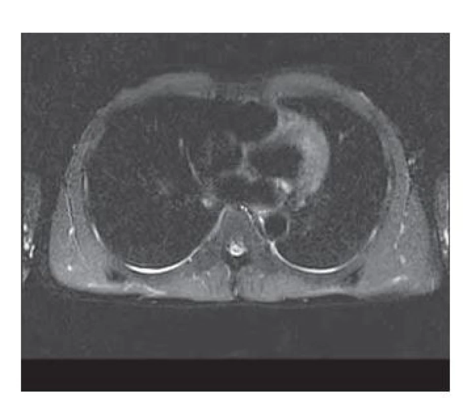 MRCP – diskrétny fluidotorax
bilaterálne (do 5 mm).<br>
Fig. 1. MRCP – discrete fluidothorax
bilaterally (up to 5 mm).