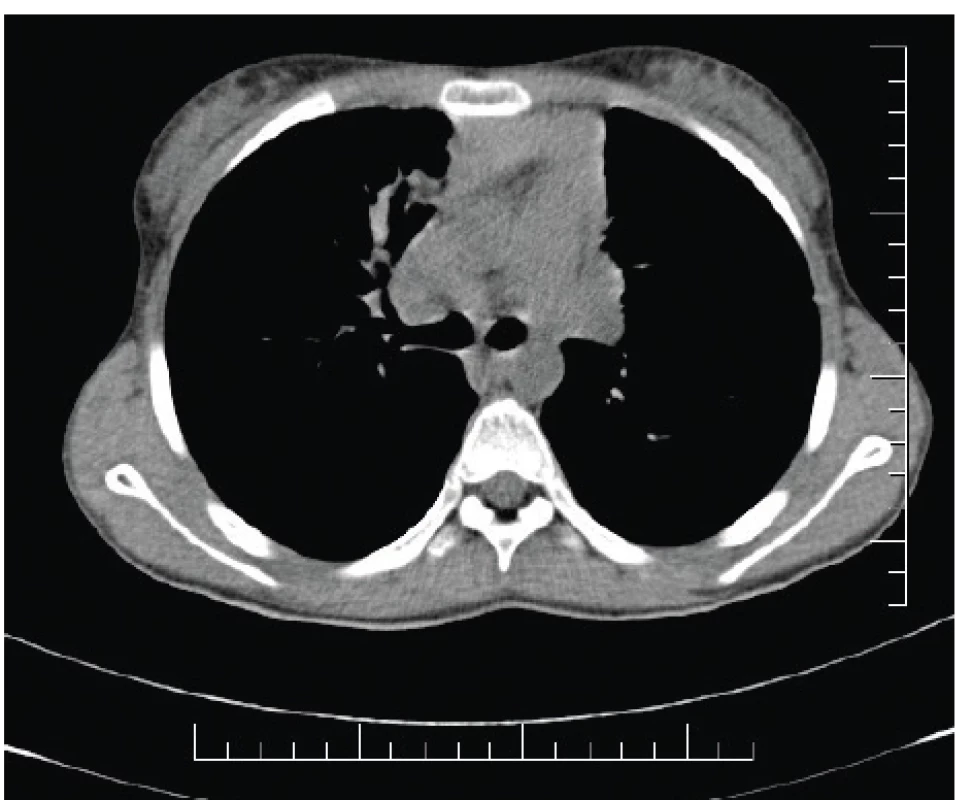 High-attenuation mucus (HAM) prítomný vpravo parakardiálne
u našej pacientky (#005).<br>
Fig. 3. High-attenuation mucus (HAM) present in the righ
lung field paracardially in our patient (#005).