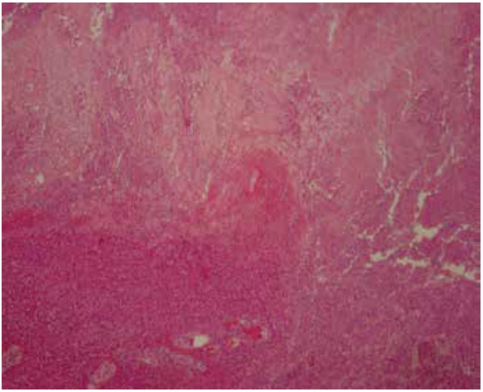 Necrotising tonsillitis of the left palatine tonsil (H&E, 40x).
