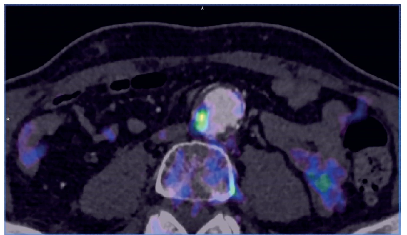 PET/CT – locally increased activity at the site of an
atherosclerotic plaque