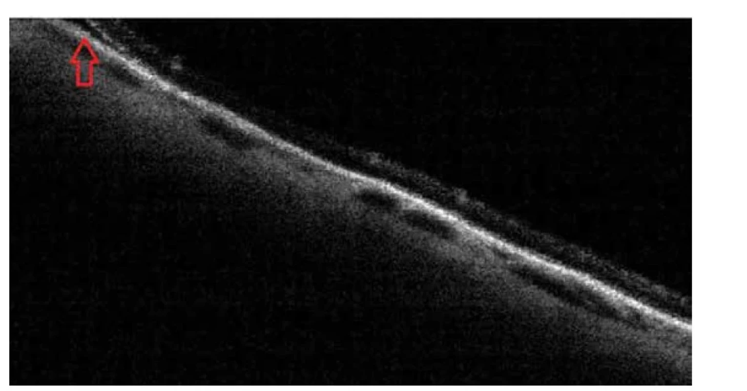 Vyšetření optickou koherenční tomografií, červená šipka zvýrazňující separaci neurosenzorické
části sítnice s přítomností subretinální tekutiny u nemocného č. 10